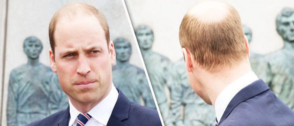 balding-at-the-crown