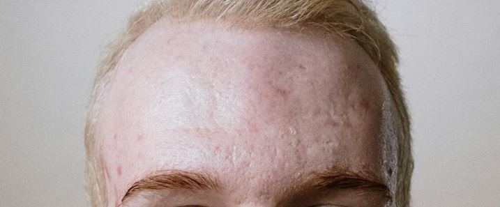 Forehead acne