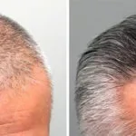 Lipogaine vs Rogaine