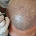 6 Vital Things About Scalp Micropigmentation You’re Probably Not Aware Of