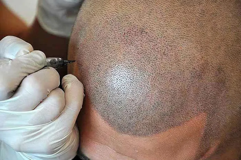 baldinglife-scalp-micropigmentation